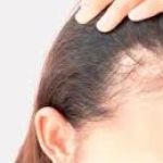Alopecia Areata Treatment in Dubai