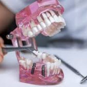Best Dental Implantologist in Delhi | Dr. M Jetley 