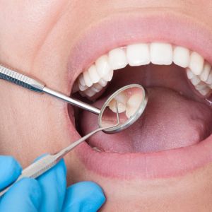 Dental Extractions In Dubai