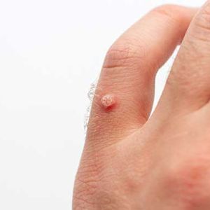 How To Choose The Right Treatment For Warts?