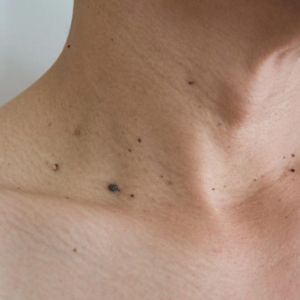 How to Get Rid of Skin Tags Removal in Dubai