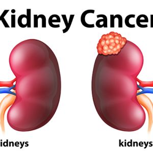 Kidney Cancer Treatments in Bangalore | Worldofurology 