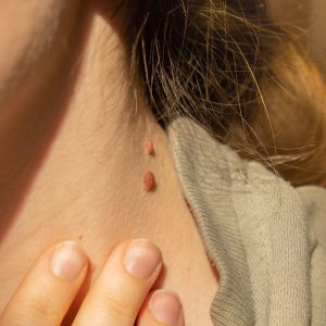 Skin Tag Removal: What Do You Need To Know?